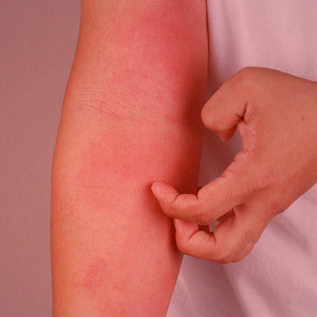 Does Red Light Therapy Help With Eczema