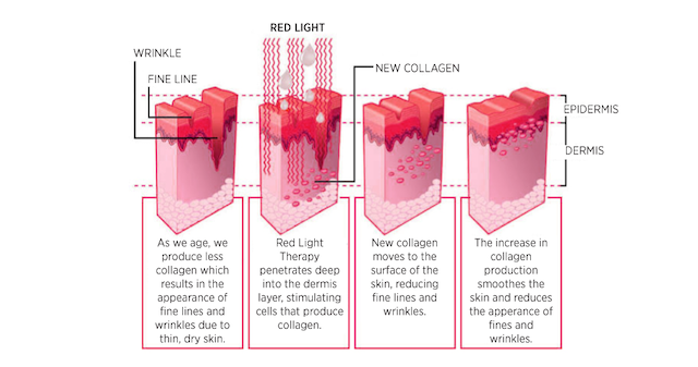 Infrared Light Therapy for Wrinkles